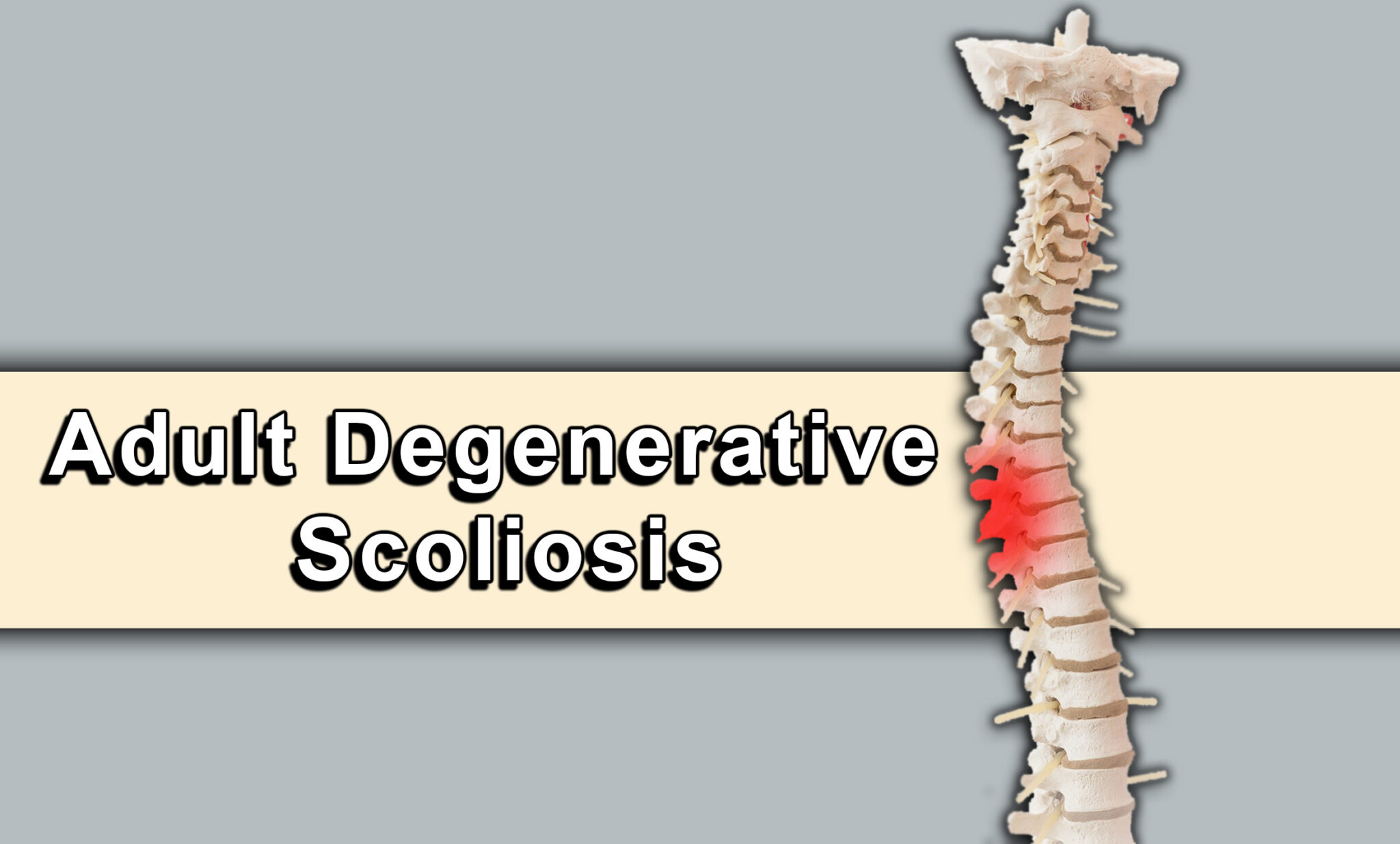 Adult Degenerative Scoliosis - Health For Best Life