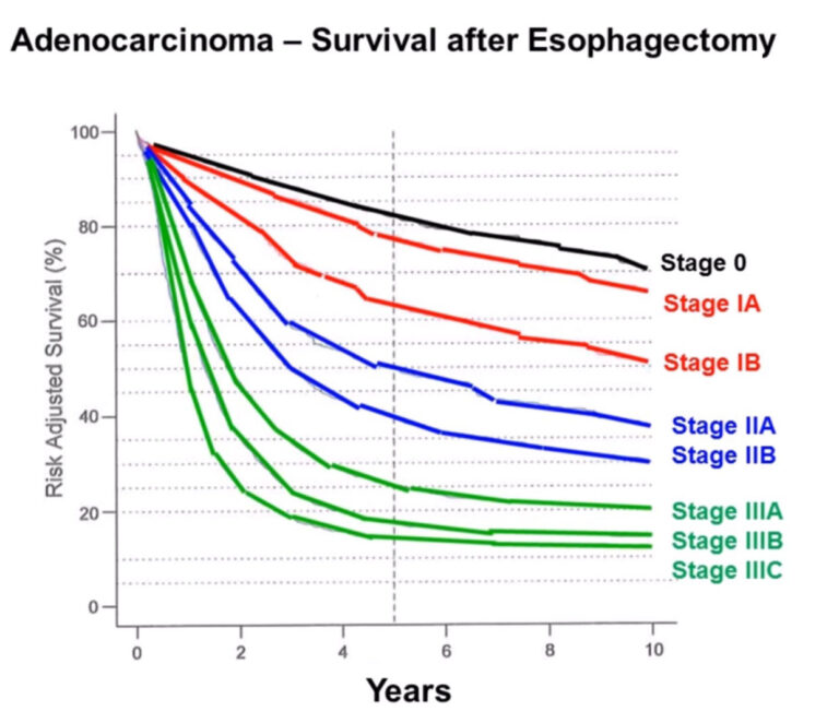 symptoms-of-esophageal-cancer-health-for-best-life