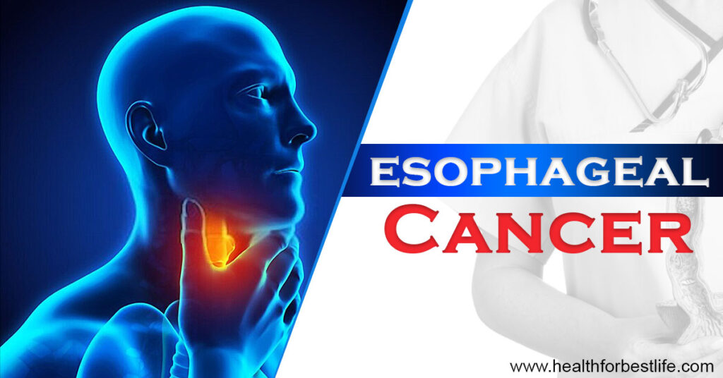 Symptoms Of Esophageal Cancer Health For Best Life