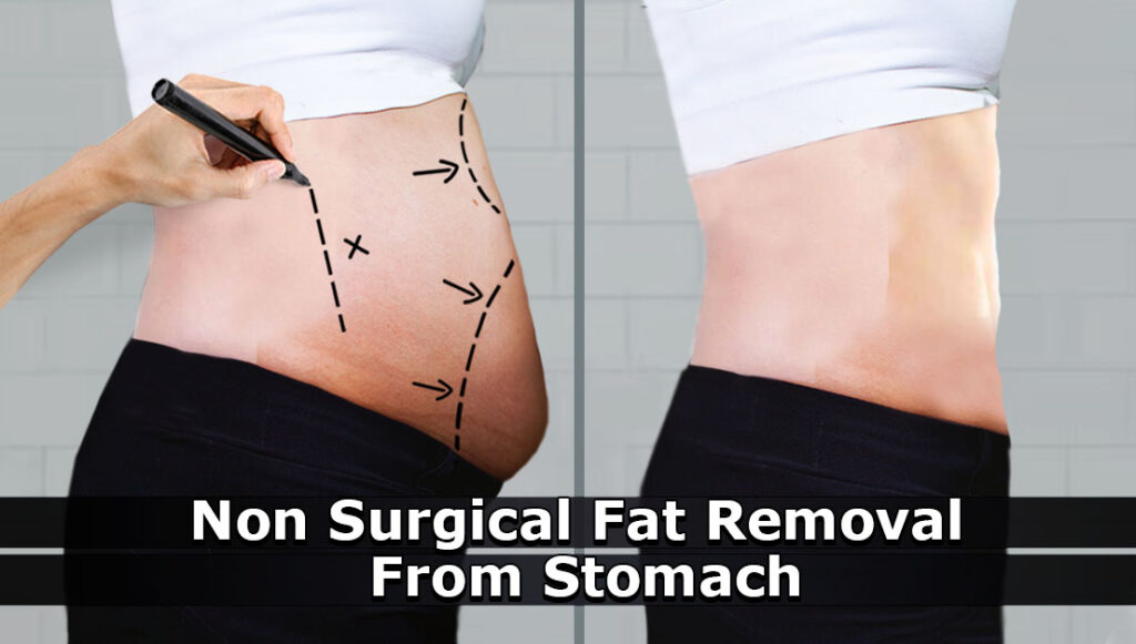 Non Surgical Fat Removal From Stomach Health For Best Life