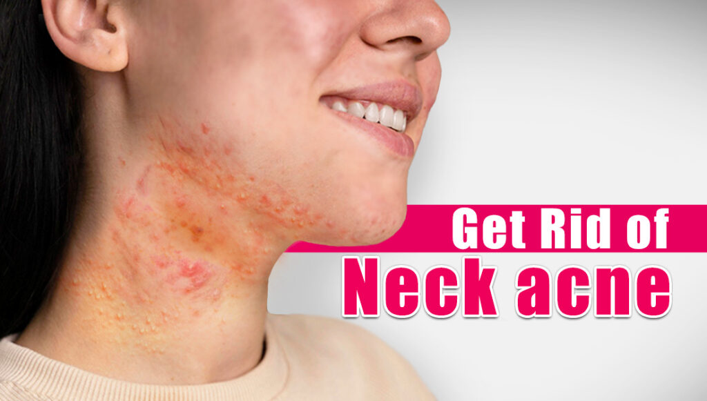 How To Get Rid Of Small Acne On Chin